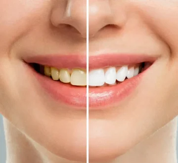 Which Option Is Best for You: Professional Teeth Whitening Vs. At-Home Teeth Whitening