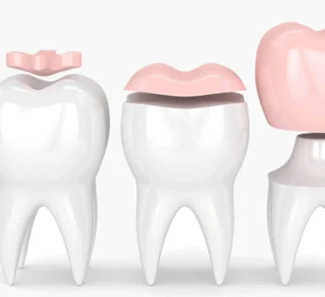 When and why should we consider the use of dental inlays and overlays?