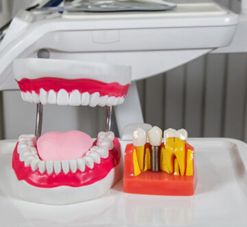 Same Day Crowns: The Future of Dental Restoration