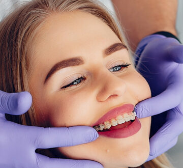 How Do Fastbraces Work for Teeth Straightening?