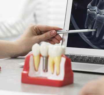 What Exactly to Expect From the Dental Implant Healing Process